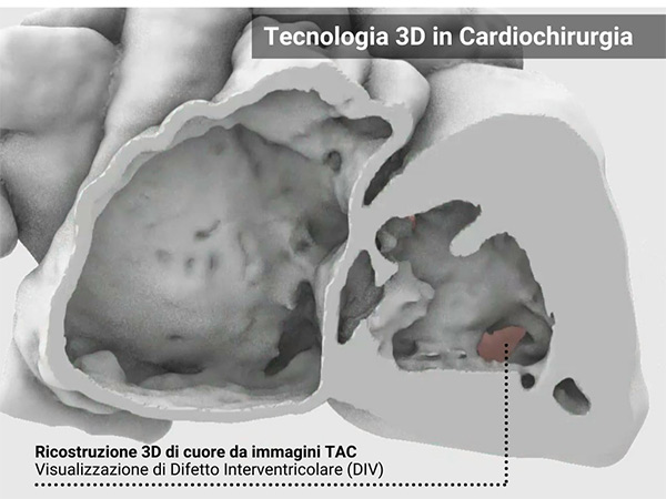 Tecnologia 3D in cardiochirurgia