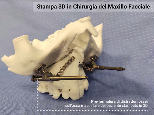 Stampa 3D chirurgia maxillo facciale