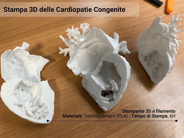 Stampa 3D cardiopatie congenite