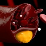 Ipercolesterolemia: modelli organizzativi per la gestione delle cronicità