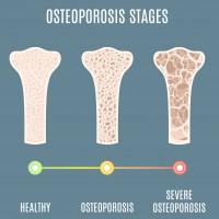 Osteoporosi severa: in Regione Piemonte il PTDA come strumento ottimale per la gestione della patologia